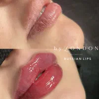 جشنواره عید تزریقات زیبایی در کلینیک لندن