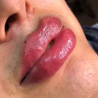 خدمات ژل و بوتاکس|خدمات آرایشگری و زیبایی|ساری, |دیوار