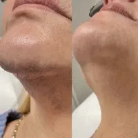 جشنواره پاییزه لیزرموهای زائد ریزش تضمینی در مطب|خدمات آرایشگری و زیبایی|زنجان, |دیوار