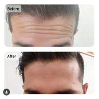 تخفیف بوتاکس فقط ۹۰۰ لیزر ۷۵۰