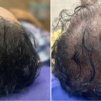 میکروپیگمنتیشن و میکرواسکالپ