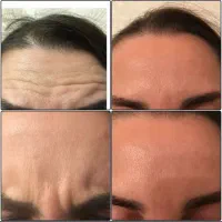 مدل رایگان ژل و بوتاکس و مزو prpو مزو نیدلینگ