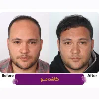 کاشت مو و کاشت ابرو با تراکم بالا بدون درد|خدمات آرایشگری و زیبایی|مشهد, احمدآباد|دیوار