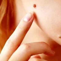 خدمات پلکسر از بین بردن خال وزیگیل|خدمات آرایشگری و زیبایی|پاکدشت, پاکدشت (مامازند)|دیوار