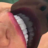 کامپوزیت نیازمند دندانپزشک زیبایی کامپوزیت