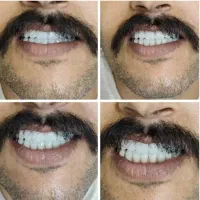 دندان مصنوعی اقساطی|خدمات آرایشگری و زیبایی|اصفهان, عطار نیشابوری|دیوار