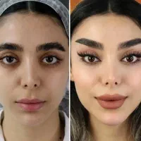 مینی لیفت شقیقه گونه لیفت چشم ابرولب