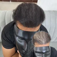 میکرواسکالپ / مکمل کاشت مو|خدمات آرایشگری و زیبایی|دوگنبدان, |دیوار