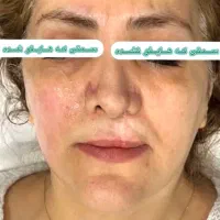 هایفو تراپی درمان و رفع شلی و افتادگی پوست(گلبرگ)