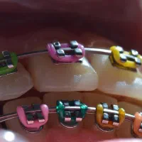 ارتودنسی ثابت و متحرک با اقساط بلند مدت|خدمات آرایشگری و زیبایی|میانه, |دیوار