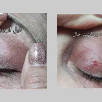 لیزر موهای زائدسوپرانو تیتانیوم وخالبرداری|خدمات آرایشگری و زیبایی|صدرا-فارس, فاز ۱|دیوار