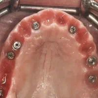 جشنواره تخفیف ایمپلنت در تبریز،با روکش فقط ۱۶تومن|خدمات آرایشگری و زیبایی|خوی, |دیوار