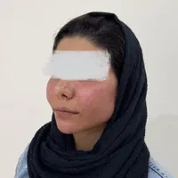 مطب زنان لابیاپلاستی غبغب بوکالفت تزریق چربی|خدمات آرایشگری و زیبایی|تهران, عبدل‌آباد|دیوار