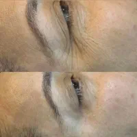 بوتاکس صورت و جوانسازی در یک هفته