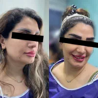 کاشت ابرو زیر بیست میلیون|خدمات آرایشگری و زیبایی|گرگان, |دیوار