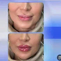 قسطی زیبا شو.  ژل.بوتاکس ..