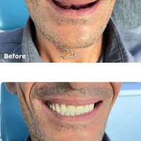 دندان مصنوعی اقساط و بیمه|خدمات آرایشگری و زیبایی|کرمان, |دیوار