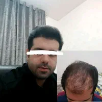 کاشت مو و ابرو در شیراز