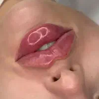 آموزش و تزریق فیلر و بوتاکس