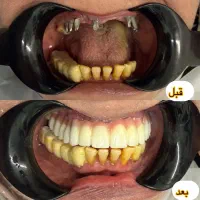 لمینت فقط با روزی 300 هزارتومان