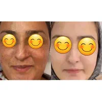 کرم ضد لک روشن کننده قوی گلدن کویین|آرایشی، بهداشتی، درمانی|شیراز, اصلاح‌نژاد|دیوار