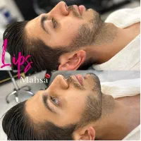 تزریق فیلر لب،ژل لب، بوتاکس،زاویه سازی،لب روسی