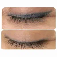 ریموو تاتو، پاک کردن تتو تخصصی کرج، البرز