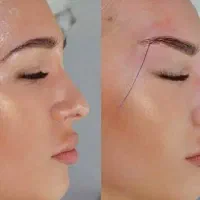 تزریق چربی .فیلر.نخ.ژل|خدمات آرایشگری و زیبایی|جهرم, |دیوار