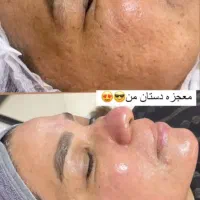 خدمات فیشیال ، پاکسازی ، جوانسازی پوست|خدمات آرایشگری و زیبایی|قم, شهرک قدس|دیوار