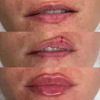 تزریق ژل و بوتاکس