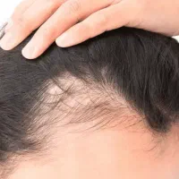 ریزش مو ( تقویت عمومی موی سر)