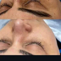پاکسازی و فیشال صورت|خدمات آرایشگری و زیبایی|سمنان, |دیوار