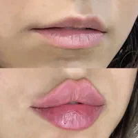 تزریق فیلر لب