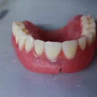 دندان مصنوعی متحرک