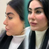 بوتاکس/فیلر صورت/کلینیک فرسیما/بوتاکس/نخ