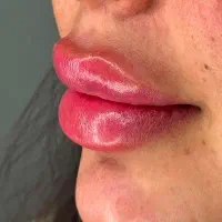 *تخفیف ویژه ژل و بوتاکس*