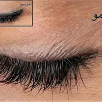 پاک کردن و ریموو تاتو صورت بدون عوارض و در یک جلسه|خدمات آرایشگری و زیبایی|تهران, دهکده المپیک|دیوار