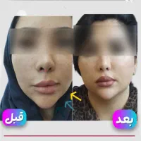 مرکز تخصصی تزریق فول فیس چربی و فیلر/لیفت با نخ|خدمات آرایشگری و زیبایی|مشهد, هنرستان|دیوار