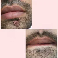 درمان قطعی و ریشه ای زگیل و تبخال