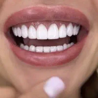 ایمپلنت ،ارتودنسی ،زیبایی با وام و اقساط ۱۵ ماهه