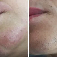 الکترولیز موهای زائدبانوان
