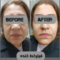 فیلرژل لب،ژل وبوتاکس تخصصی آقاوخانم در مطب پزشک|خدمات آرایشگری و زیبایی|شیراز, قصرالدشت|دیوار