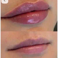 مدل برای تزریق بوتاکس و فیلر