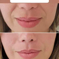 تزریق ژل لب بوتاکس مزوتراپی فیلر صورت در تهران|خدمات آرایشگری و زیبایی|تهران, فلسطین (میدان انقلاب)|دیوار