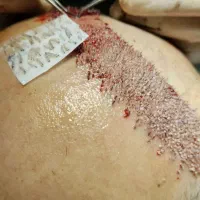 کاشت مو