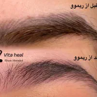 تخفیف ۵۰ درصدی ریموو تخصصی تاتو|خدمات آرایشگری و زیبایی|شیراز, تندگویان|دیوار