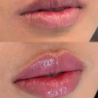 جشنواره لب وگونه/چانه و زاویه/بوتاکس،فقط توسط پزشک