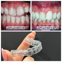 ارتودنسی نامرئی بدون سیم بدون درد - رایگان|خدمات آرایشگری و زیبایی|شیراز, نیایش|دیوار