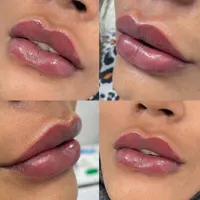 کلینیک پوست و زیبایی   ژل لب/فیلرگونه/زاویه/بوتاکس|خدمات آرایشگری و زیبایی|قم, صفائیه|دیوار