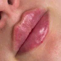 تزریق  ژل بوتاکس مطب